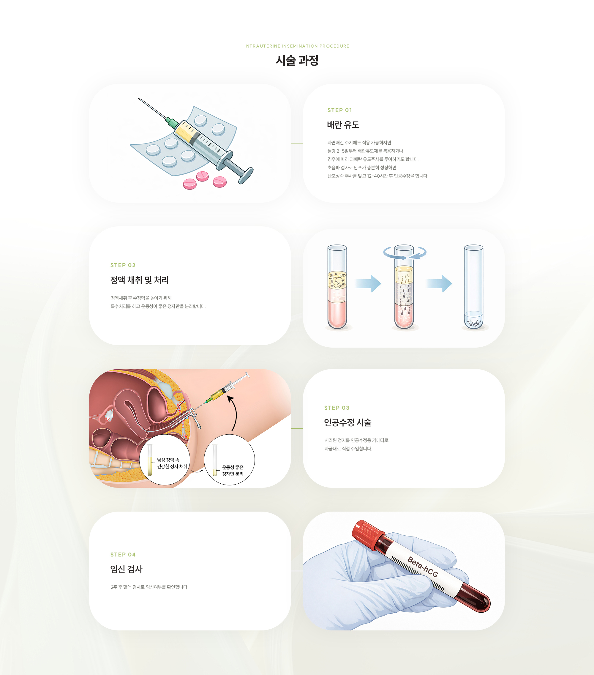 [시술 과정] {STEP 01} 배란 유도 : 자연배란 주기에도 적용 가능하지만 월경 2-5일부터 배란유도제를 복용하거나 경우에 따라 과배란 유도주사를 투여하기도 합니다. 초음파 검사로 난포가 충분히 성장하면 난포성숙 주사를 맞고 12-40시간 후 인공수정을 합니다. {STEP 02} 정액 채취 및 처리 : 정액채취 후 수정력을 높이기 위해 특수처리를 하고 운동성이 좋은 정자만을 분리합니다. {STEP 03} 인공수정 시술 : 처리된 정자를 인공수정용 카테터로 자궁내로 직접 주입합니다.  {STEP 04} 임신 검사 : 2주 후 혈액 검사로 임신여부를 확인합니다.