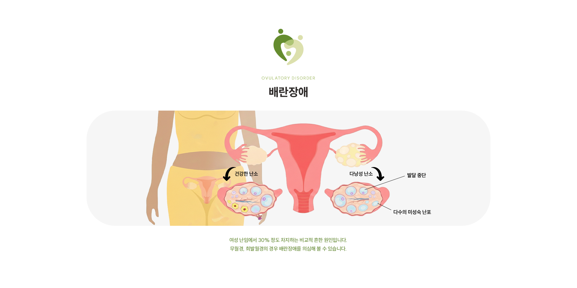 [배란장애] 여성 난임에서 30% 정도 차지하는 비교적 흔한 원인입니다. 무월경, 희발월경의 경우 배란장애를 의심해 볼 수 있습니다.