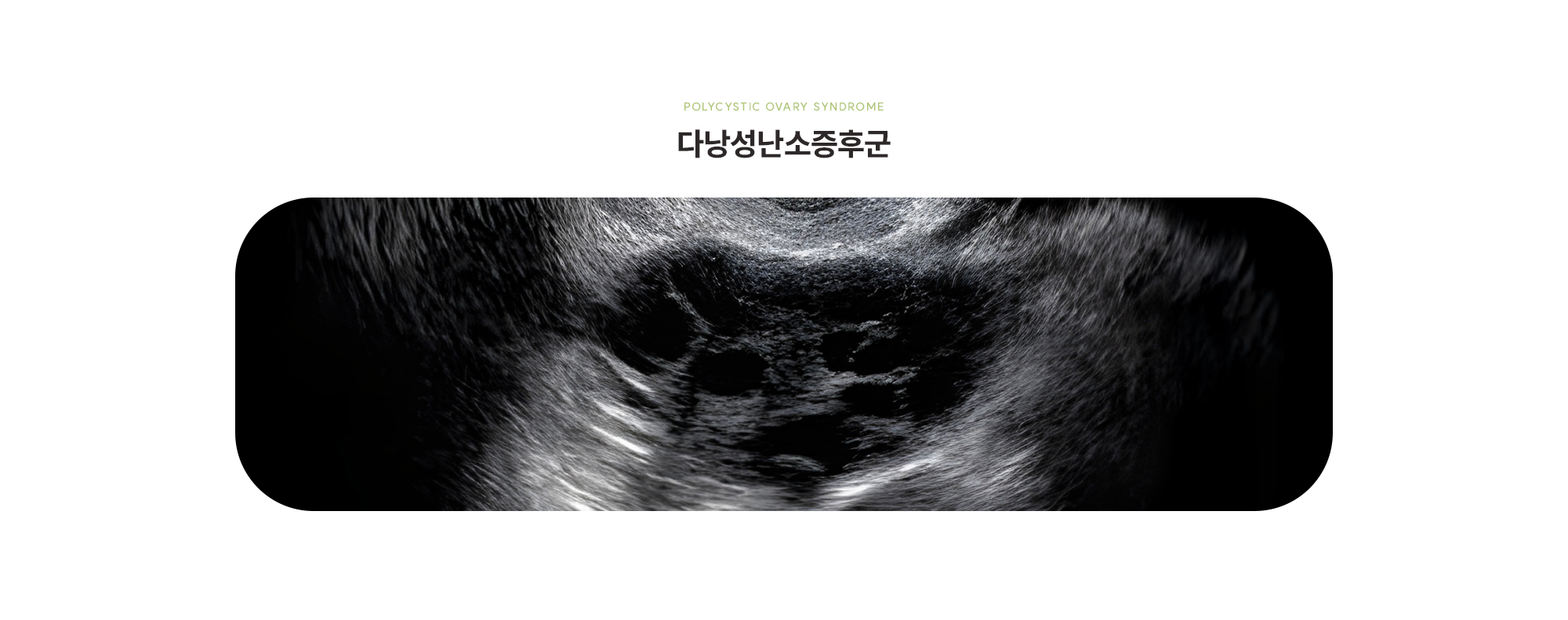 [다낭성난소증후군]