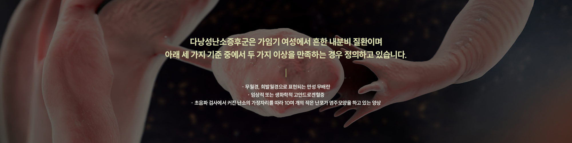 다낭성난소증후군은 가임기 여성에서 흔한 내분비 질환이며 아래 세 가지 기준 중에서 두 가지 이상을 만족하는 경우 정의하고 있습니다. / · 무월경, 희발월경으로 표현되는 만성 무배란  · 임상적 또는 생화학적 고안드로겐혈증  · 초음파 검사에서 커진 난소의 가장자리를 따라 10여 개의 작은 난포가 염주모양을 하고 있는 양상